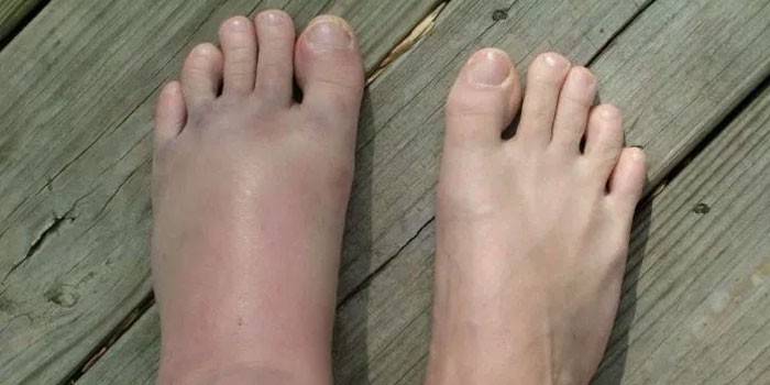 Ligamentitída chodidla