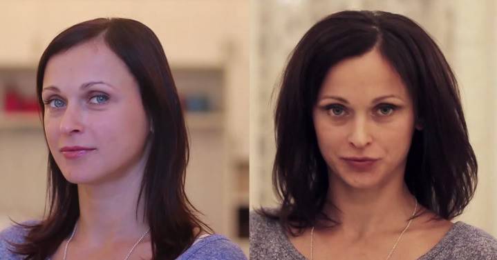 Mujer antes y después del procedimiento.