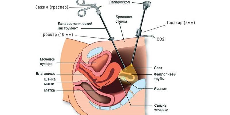 Laparoscopia de miomas uterinos