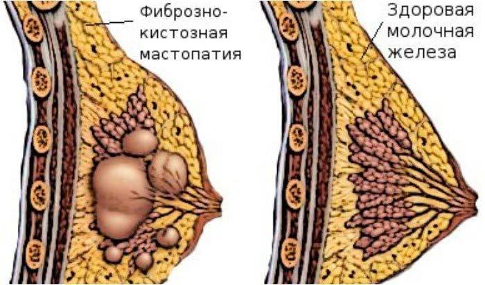 Fibrocystická mastopatia