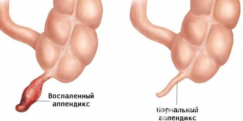 Zapalenie i normalne zapalenie wyrostka robaczkowego