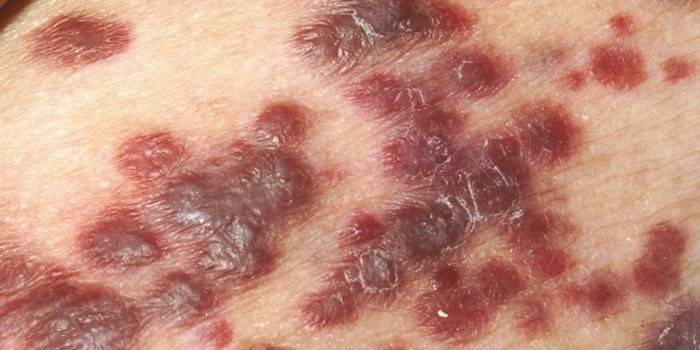 Kaposiho choroba Sarcoma