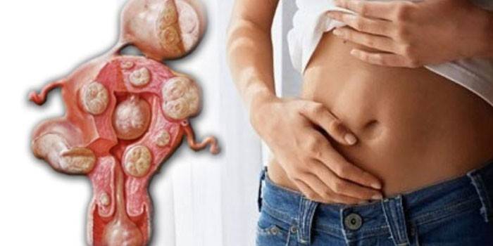 Miomas uterinos