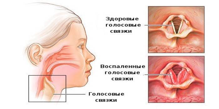 Cordas vocais inflamadas