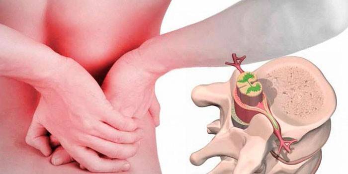 Vertebral hernia