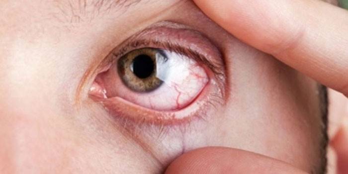 Infección micótica del ojo