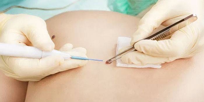 Tratamiento de neoplasias en la piel con ondas de radio.
