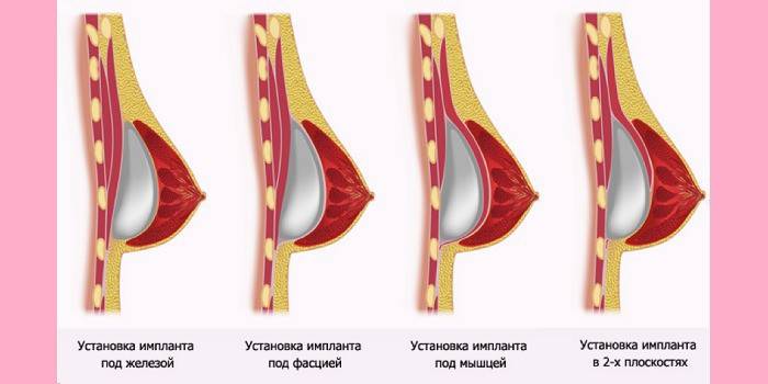 Metódy inštalácie prsných implantátov