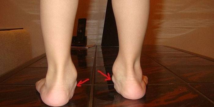 Deformidade em hálux valgo em criança