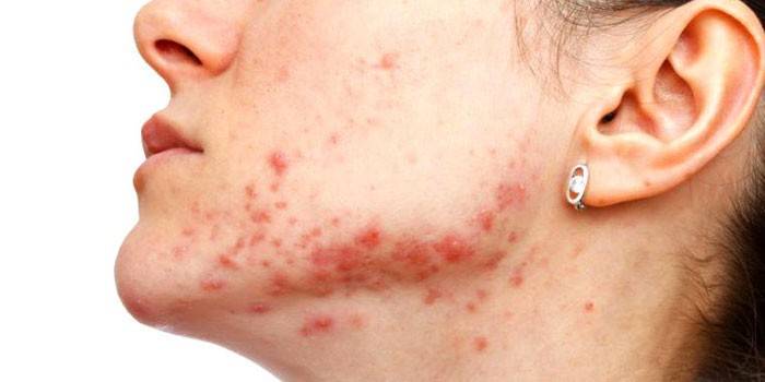 Staphylococcus em um adulto