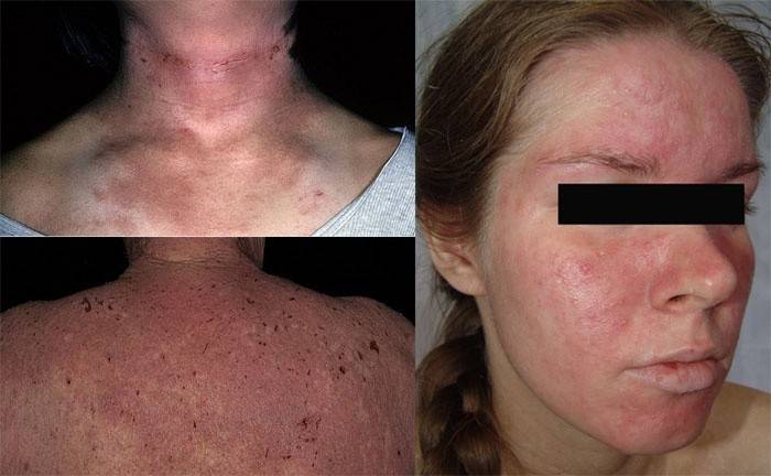 Focos de dermatite atópica