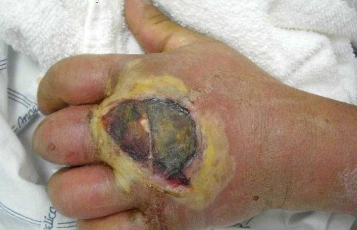 Apego de infecção por estafilococos à dermatite