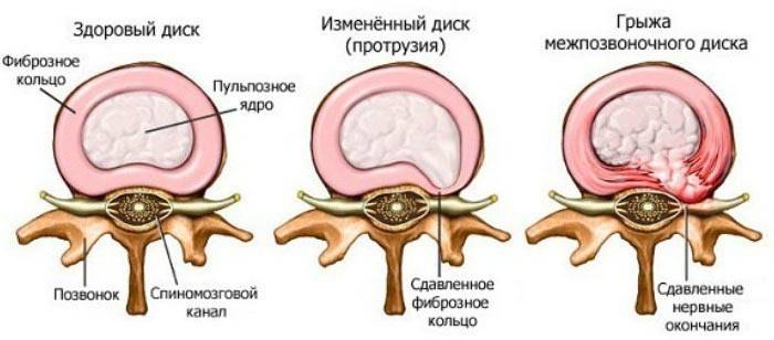 Etapy osteochondrózy