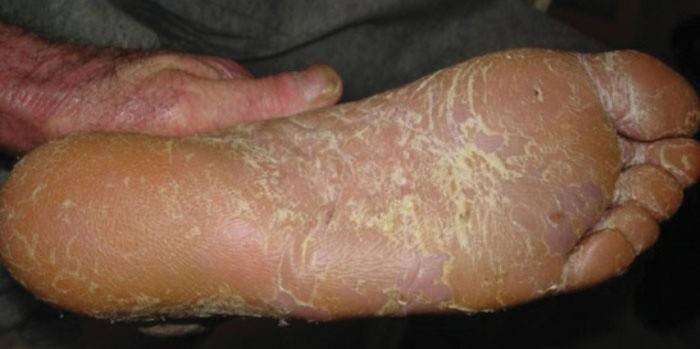 Hiperceratose única