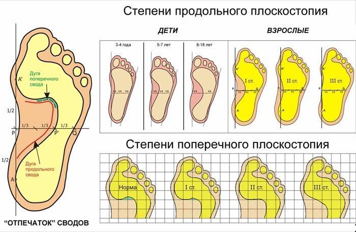 Stopień naruszenia struktury stopy na schemacie