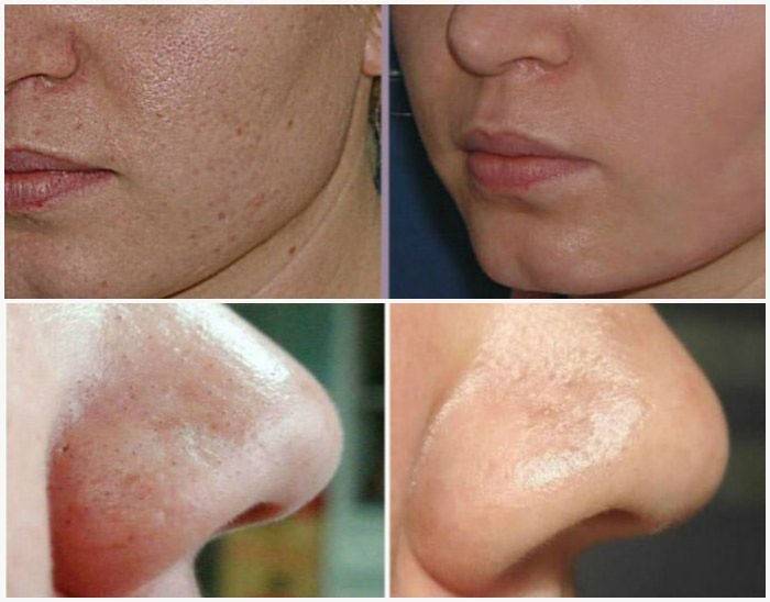 Resultados de peeling