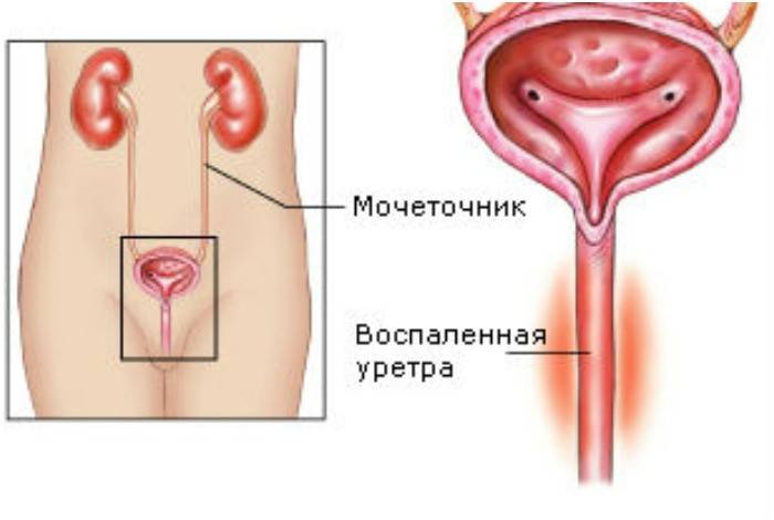 Zápal močovej trubice