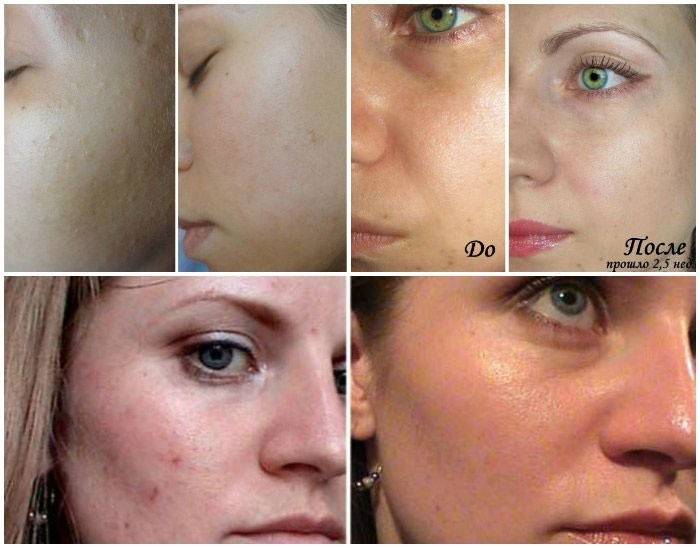 Fotos antes e depois do laser